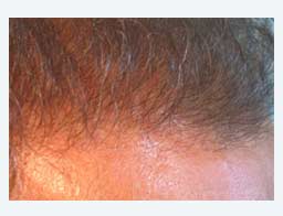 Haartransplantation mit guter Haardichte
