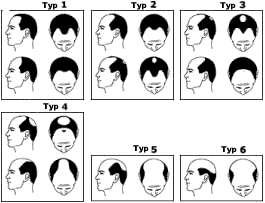 Muster der Haarsituation bei Haarausfall