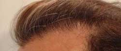 Haarlinie wichtig für eine Haarverpflanzung
