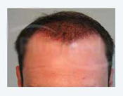 Haartransplantation Megasitzung