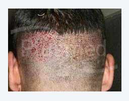 nach einer FUE Haarverpflanzung von Eigenhaar