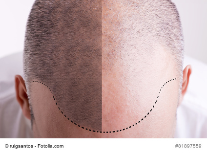 Forscher Zuchten Erfolgreich Kunstliche Haut Mit Haaren