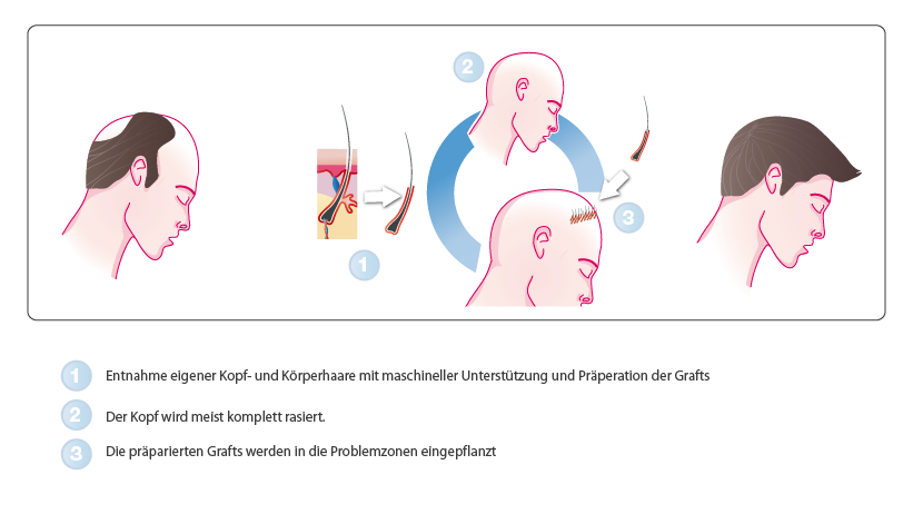 Fue Haartransplantation Kosten Fur Das Narbenfreie Und Schonende Verfahren Zur Haarverpflanzung